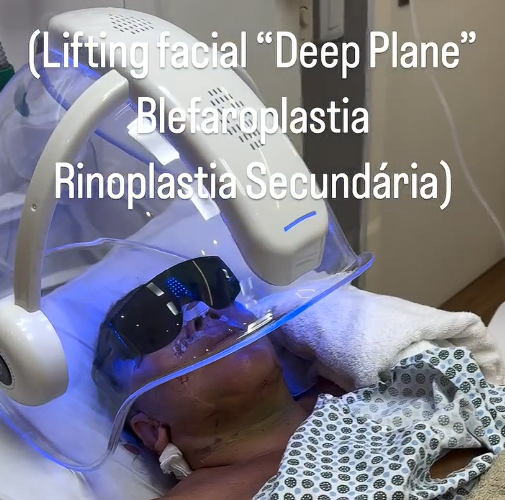 Lifting Facial e Rinoplastia Secundária com Oxigenoterapia e Ledterapia.